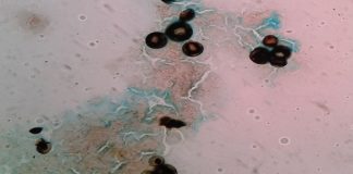 Paracoccidioidomicosis Activan alarma por aumento de casos de una enfermedad en el NEA En el NEA la PCM se ha presentado con la forma clínica crónica del adulto