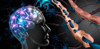 Especialista de la UNNE participó en elaboración de consenso para optimizar tratamiento de la Esclerosis Múltiple Secundaria Progresiva