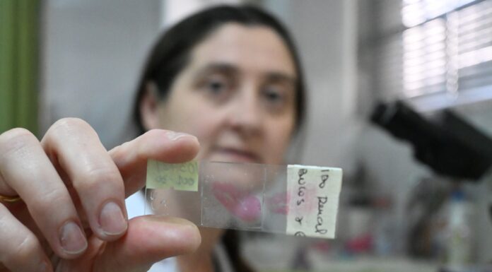 IMPORTANTES HALLAZGOS Identifican una proteína con potencial terapéutico y marcadora del pronóstico del cáncer renal más prevalente