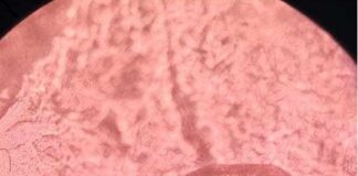 NUEVOS CONOCIMIENTOS Estudian la relación entre parásitos cutáneos con tres enfermedades frecuentes de la piel