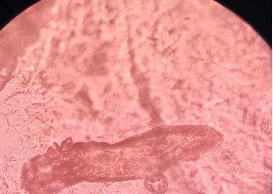 NUEVOS CONOCIMIENTOS Estudian la relación entre parásitos cutáneos con tres enfermedades frecuentes de la piel