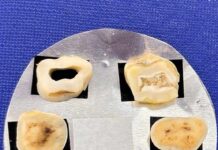 Nuevos Conocimientos Estudian un tratamiento a base de propóleo para combatir la sensibilidad dental