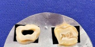 Nuevos Conocimientos Estudian un tratamiento a base de propóleo para combatir la sensibilidad dental