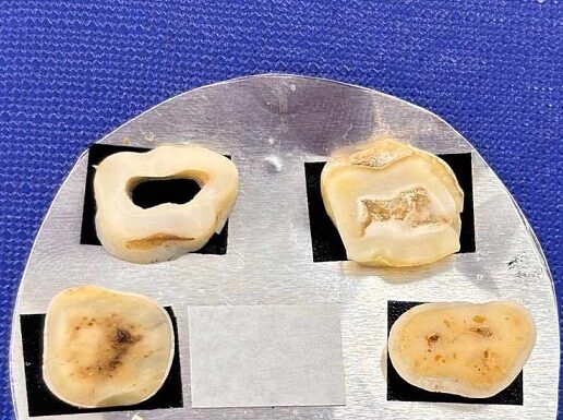 Nuevos Conocimientos Estudian un tratamiento a base de propóleo para combatir la sensibilidad dental