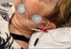 Confirman que la electroestimulación muscular reduce el tiempo de recuperación en casos de parálisis facial