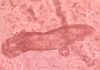 Investigan si los tratamientos para la psoriasis alteran la presencia de un ácaro que vive en la piel