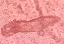Investigan si los tratamientos para la psoriasis alteran la presencia de un ácaro que vive en la piel