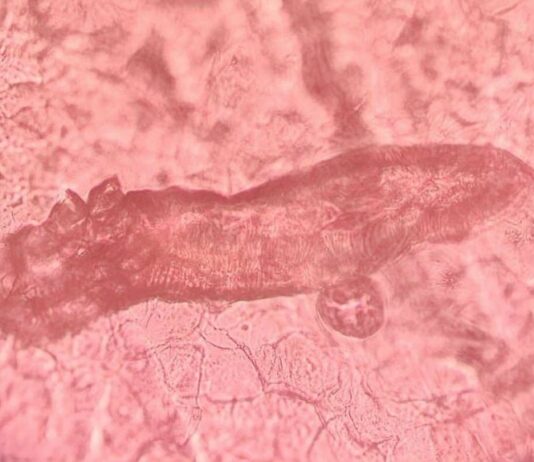 Investigan si los tratamientos para la psoriasis alteran la presencia de un ácaro que vive en la piel