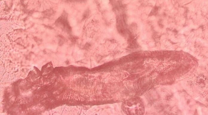 Investigan si los tratamientos para la psoriasis alteran la presencia de un ácaro que vive en la piel