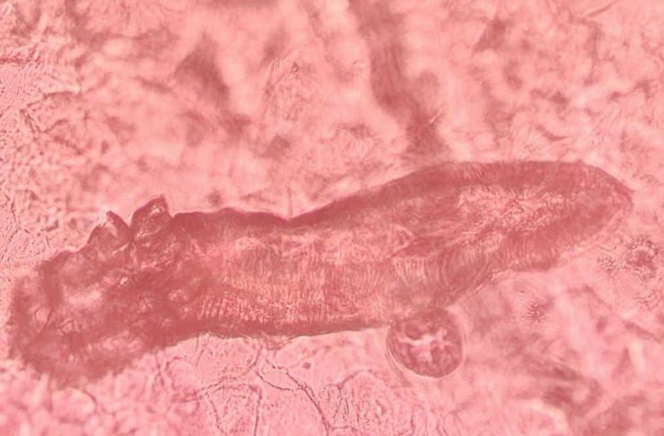 Investigan si los tratamientos para la psoriasis alteran la presencia de un ácaro que vive en la piel