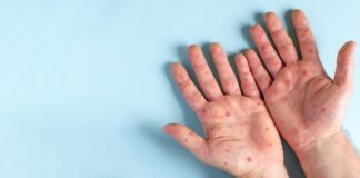 ZOONOSIS VIRAL Fiebre Símica o Mpox: “Lo principal aquí, es no transmitir pánico a la gente”