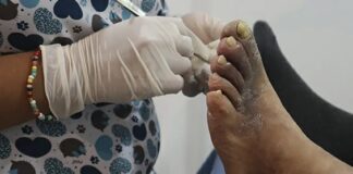 ESTUDIO UNNE Pie diabético, una problemática con alta tasa de recurrencia, reinternaciones y mortalidad