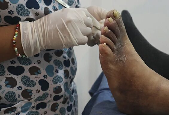 ESTUDIO UNNE Pie diabético, una problemática con alta tasa de recurrencia, reinternaciones y mortalidad