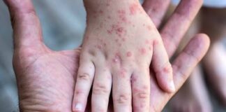 ALERTA SANITARIA Sarampión: “Estamos preocupados con el tema de la vacunación porque estamos muy por debajo del número que se desea”
