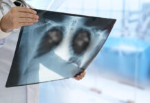 CON AUTORIZACIÓN DE ANMAT Llega a la Argentina un tratamiento que mejora sobrevida de pacientes con cáncer de pulmón