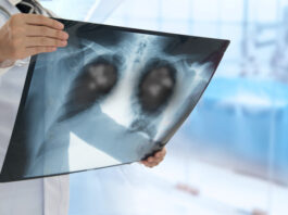 Llega a la Argentina un tratamiento que mejora sobrevida de pacientes con cáncer de pulmón