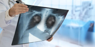 CON AUTORIZACIÓN DE ANMAT Llega a la Argentina un tratamiento que mejora sobrevida de pacientes con cáncer de pulmón