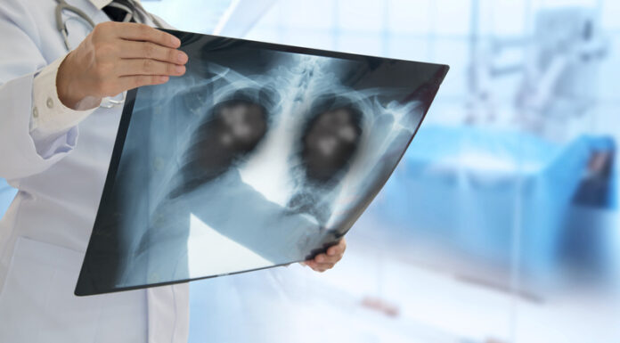 CON AUTORIZACIÓN DE ANMAT Llega a la Argentina un tratamiento que mejora sobrevida de pacientes con cáncer de pulmón